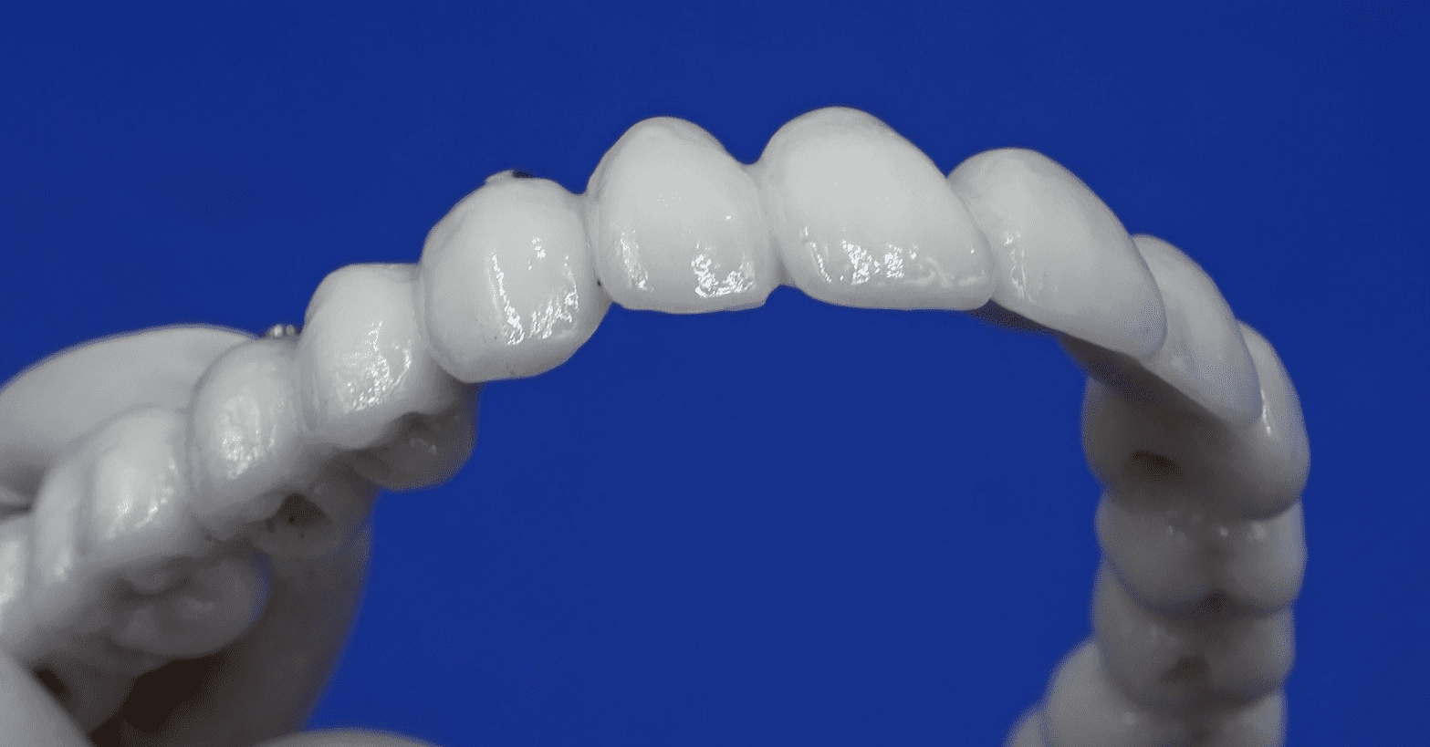 Ceramica vs Resina: Perché la Protesi Definitiva Conta Quanto l’Impianto