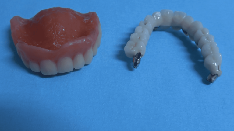 Denti con Finta Gengiva: Il Segreto Inconfessabile delle Protesi Economiche